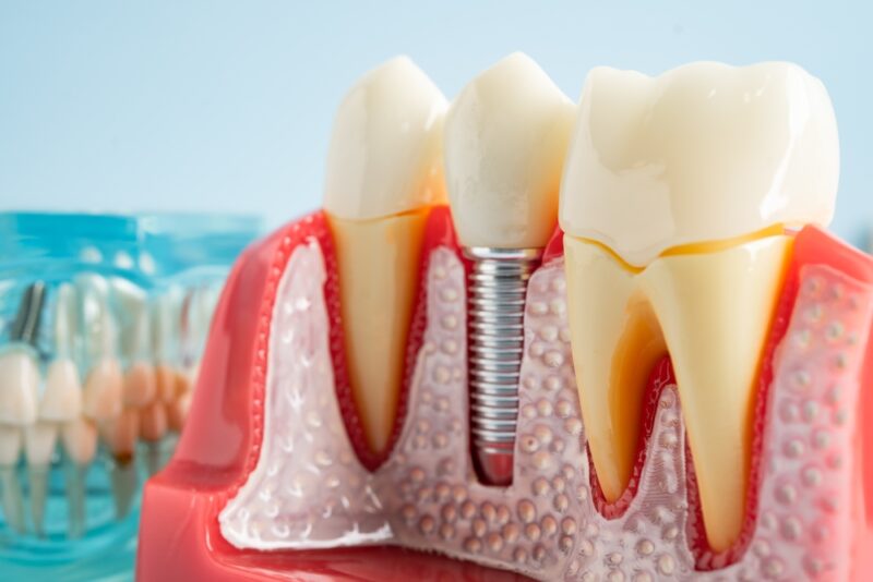 Dental Implants New Braunfels