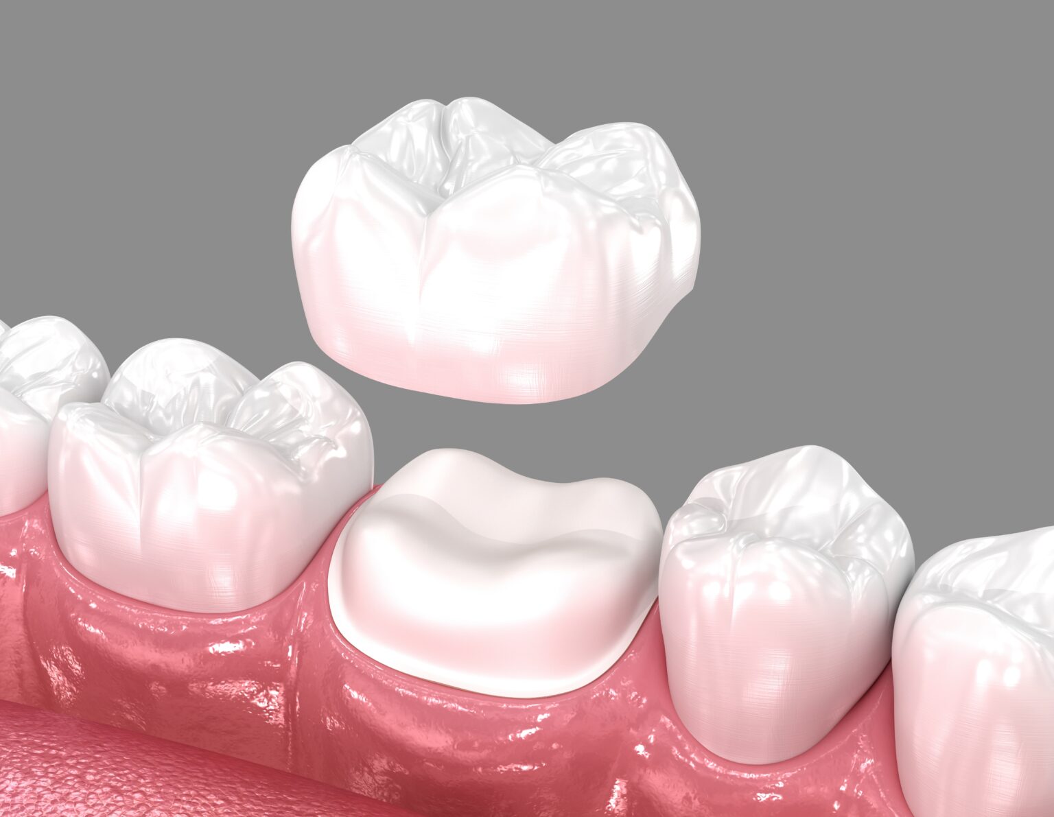 Dental Crowns New Braunfels
